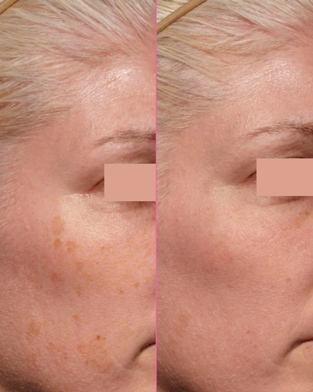 Third-party before-and-after example showing the side of a woman’s face