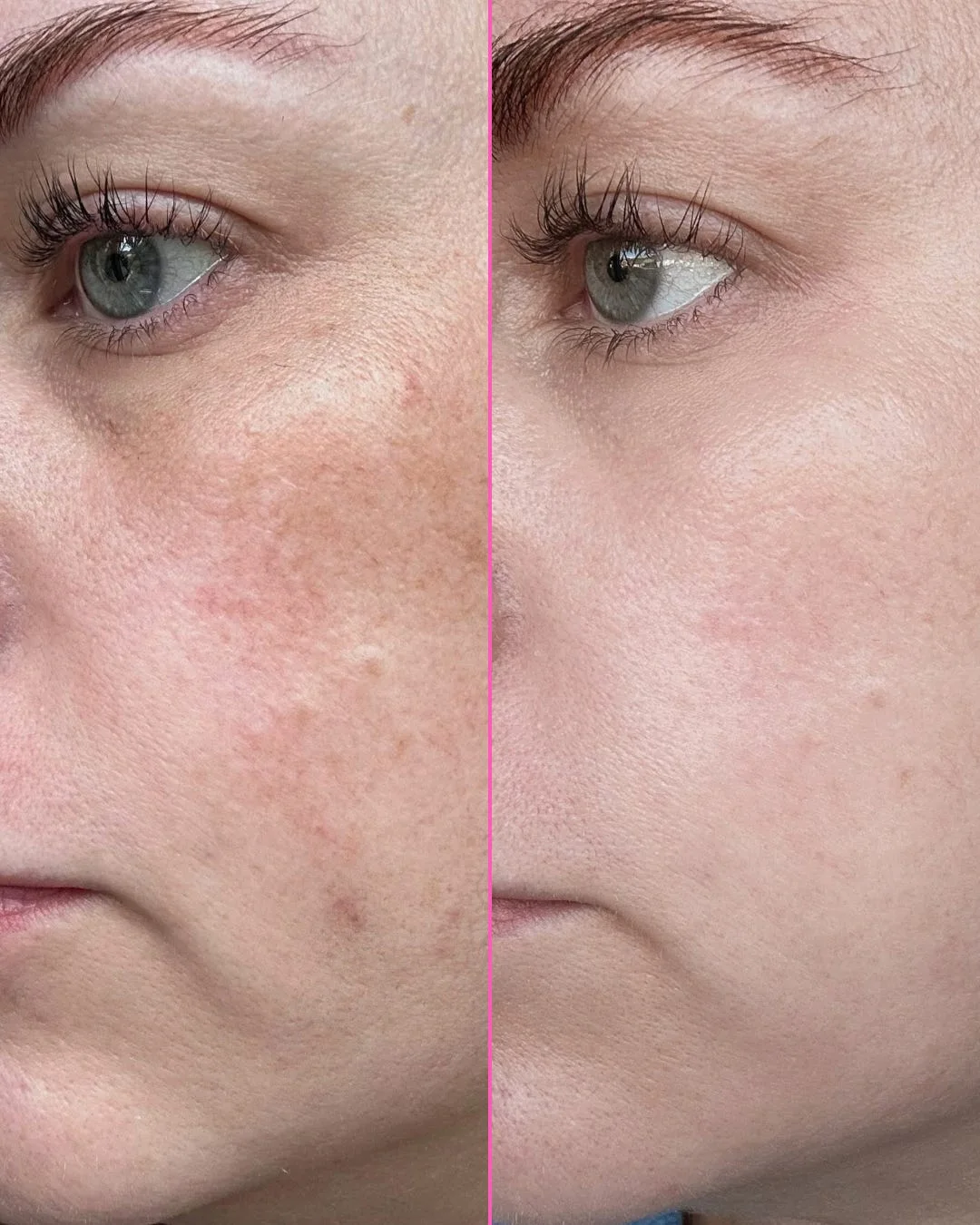 Third-party before-and-after example showing changes in facial texture and tone